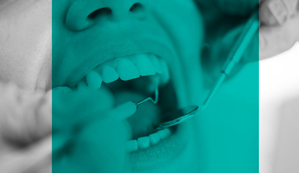 Behandlung Parodontitis in Zahnarztpraxis Karlsruhe, offener Mund